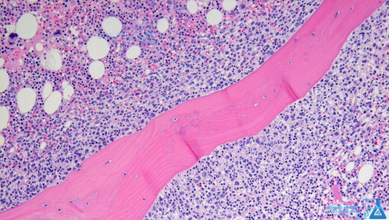 آزمایش Bone Marrow Biopsy